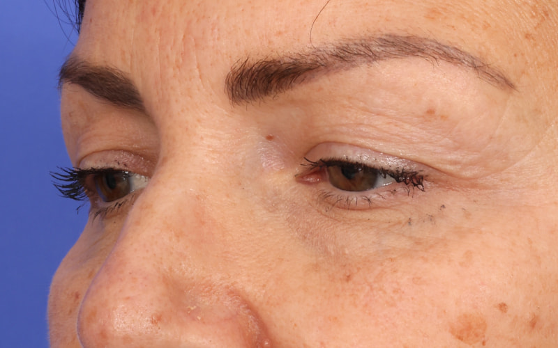 Upper Blepharoplasty Before & After Image