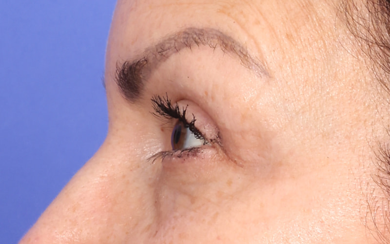 Upper Blepharoplasty Before & After Image