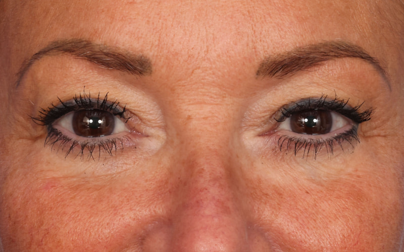 Upper blepharoplasty Before & After Image