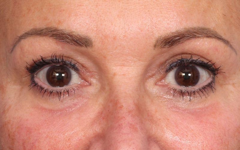 Upper blepharoplasty Before & After Image