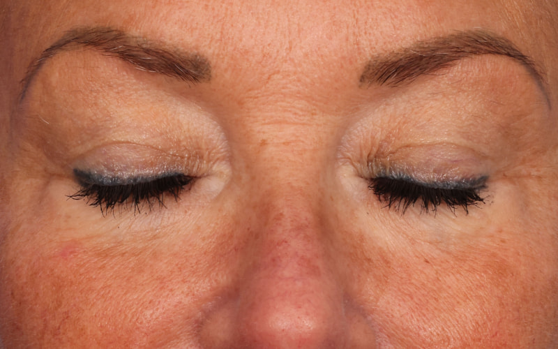 Upper blepharoplasty Before & After Image