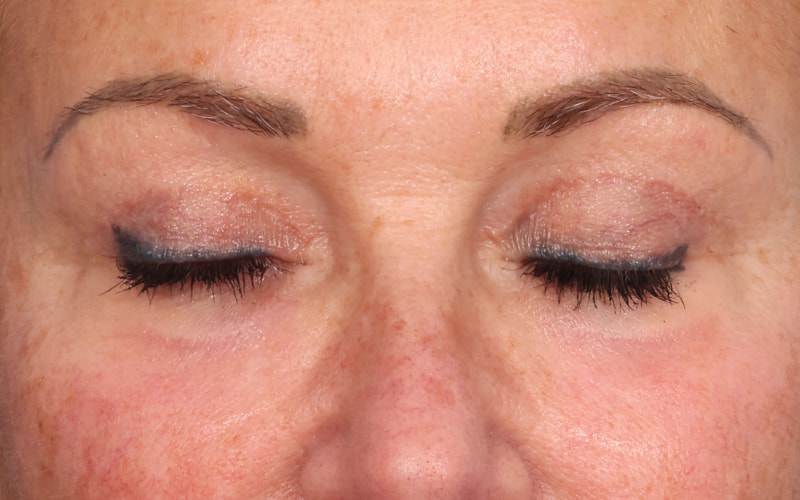 Upper blepharoplasty Before & After Image