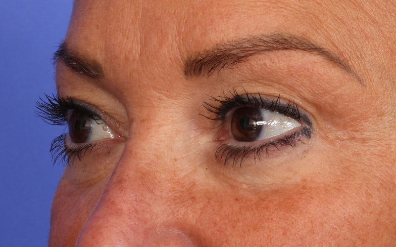 Upper Blepharoplasty Before & After Image