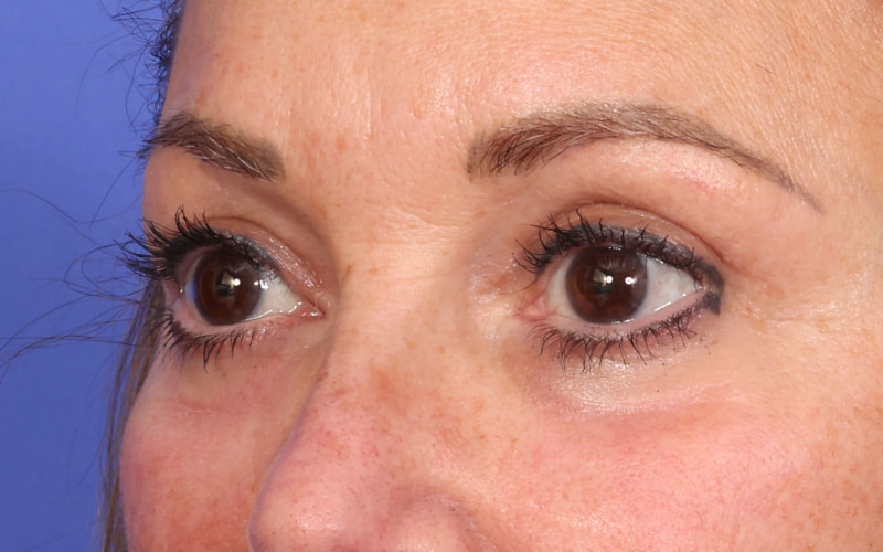Upper Blepharoplasty Before & After Image