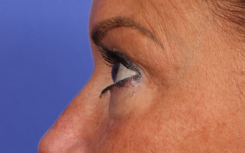 Upper Blepharoplasty Before & After Image