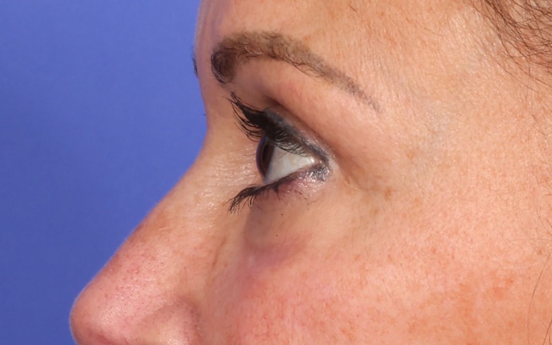 Upper Blepharoplasty Before & After Image