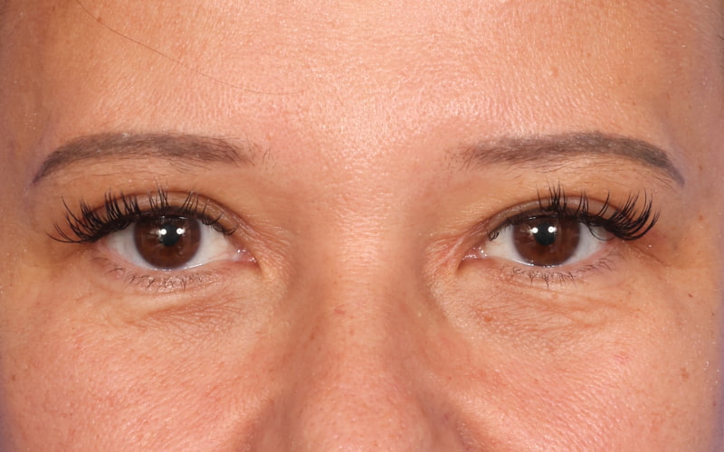 Upper blepharoplasty Before & After Image