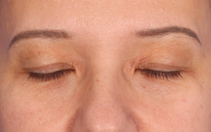 Upper blepharoplasty Before & After Image
