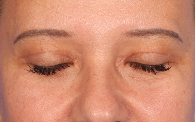 Upper blepharoplasty Before & After Image