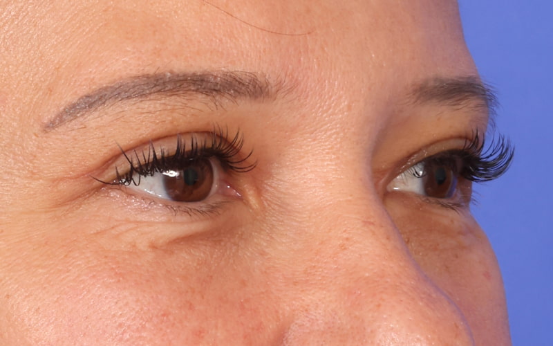 Upper Blepharoplasty Before & After Image