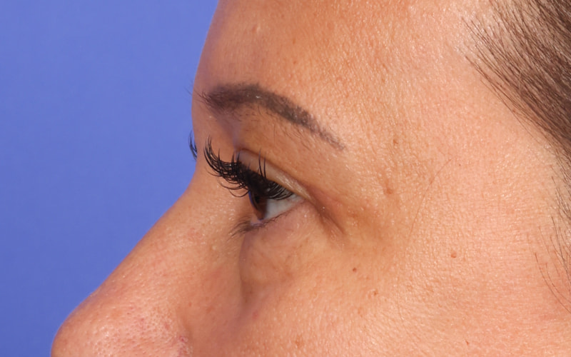 Upper Blepharoplasty Before & After Image