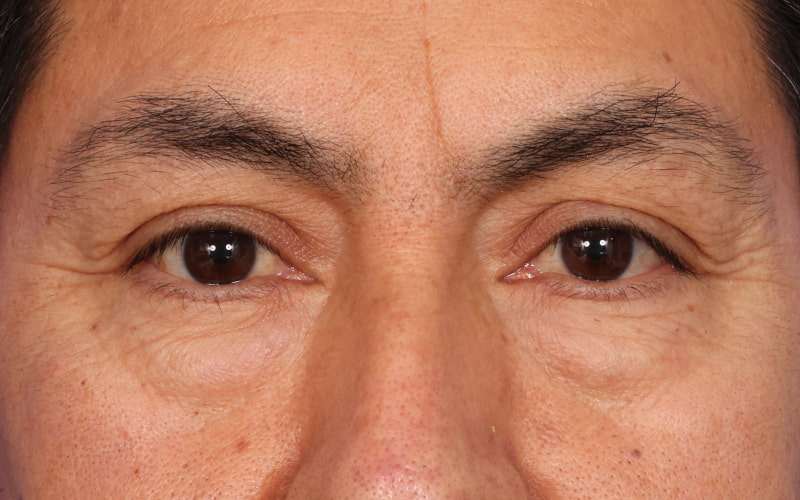 Upper blepharoplasty Before & After Image