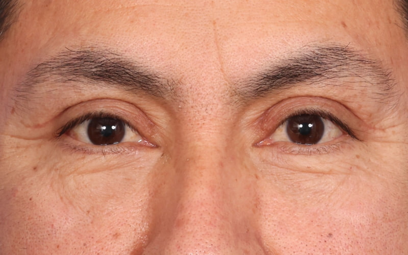 Upper blepharoplasty Before & After Image