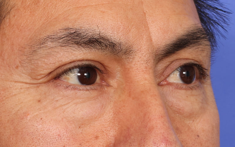 Upper blepharoplasty Before & After Image