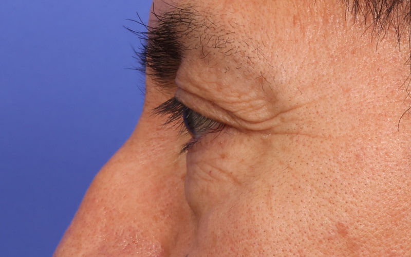 Upper Blepharoplasty Before & After Image