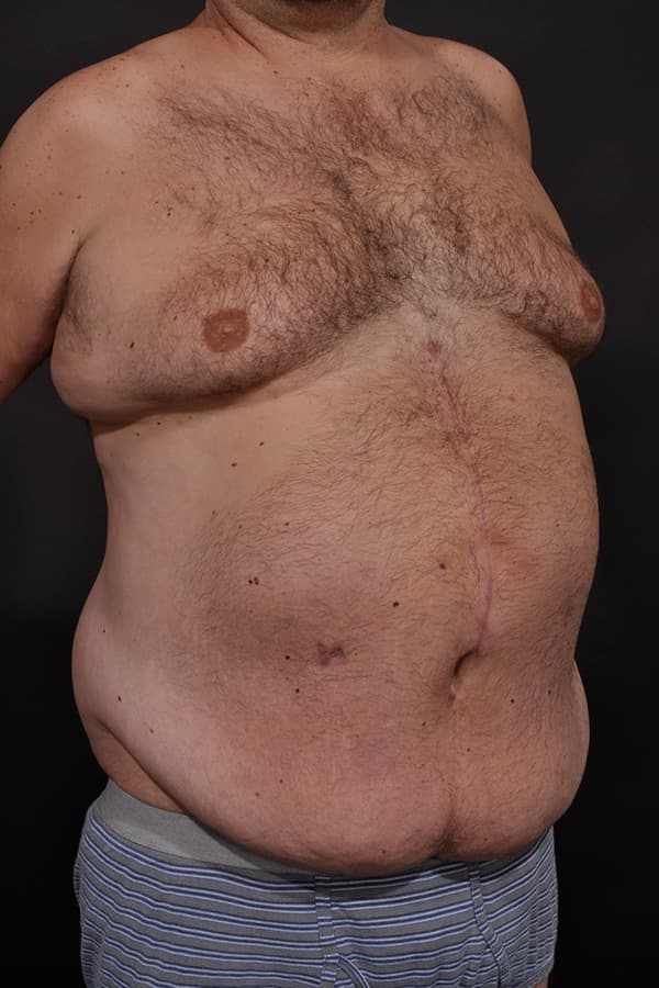 Male Abdominoplasty Before & After Image