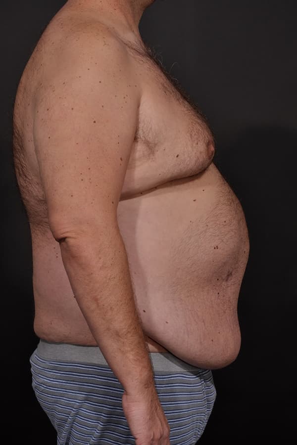 Male Abdominoplasty Before & After Image