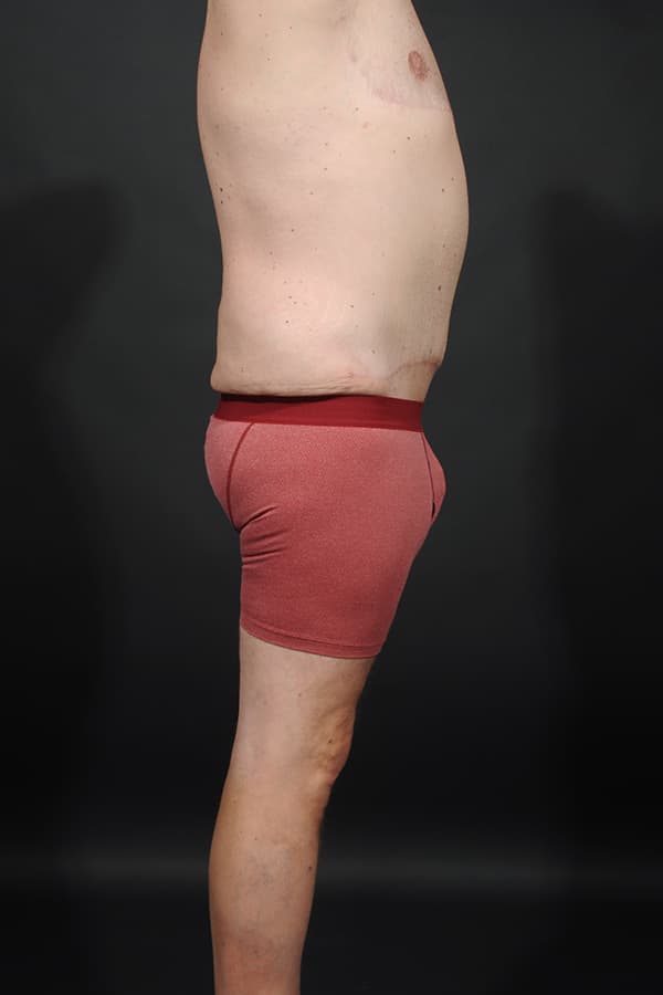 Male Abdominoplasty Before & After Image