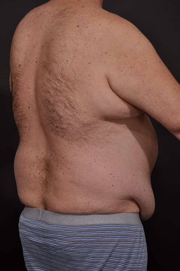 Male Abdominoplasty Before & After Image