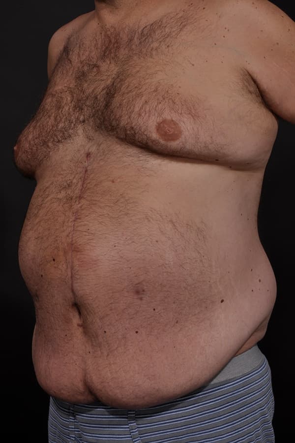 Male Abdominoplasty Before & After Image