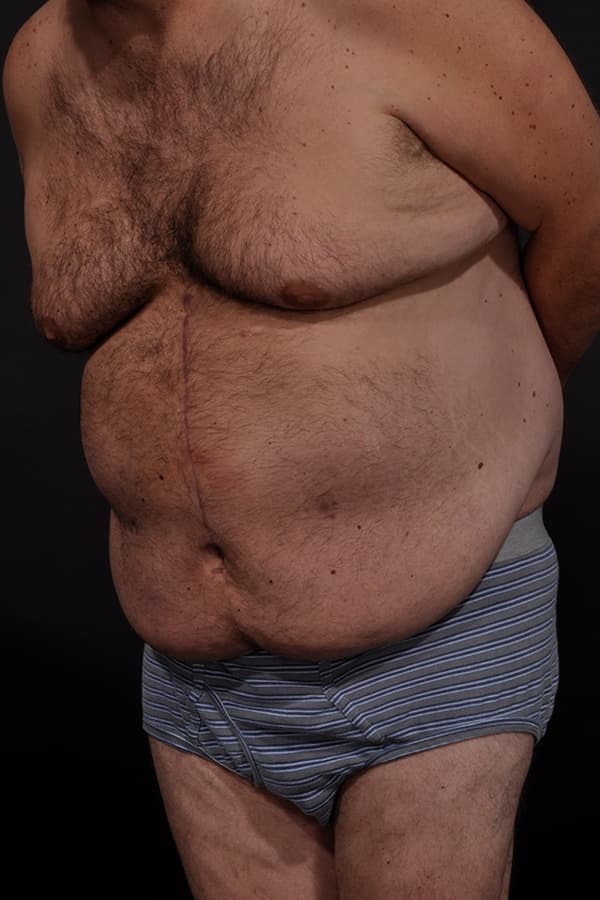 Male Abdominoplasty Before & After Image