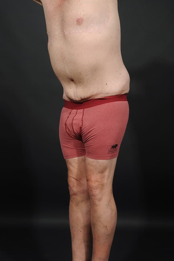 Male Abdominoplasty Before & After Image