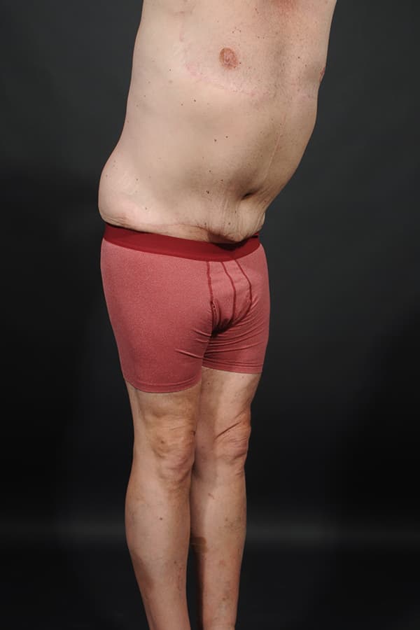 Male Abdominoplasty Before & After Image