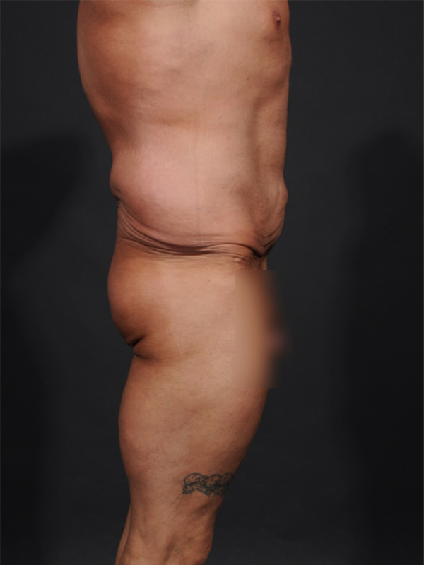 Male Abdominoplasty Before & After Image