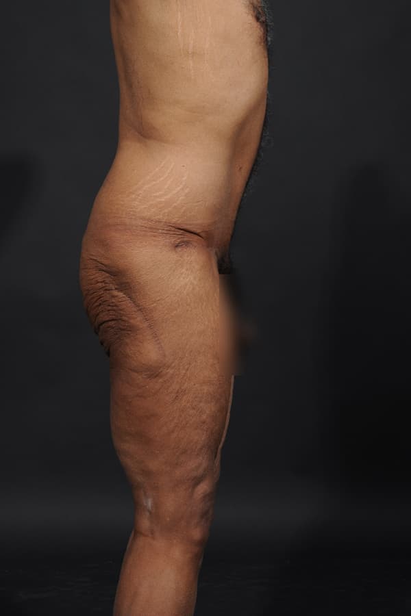 Male Abdominoplasty Before & After Image