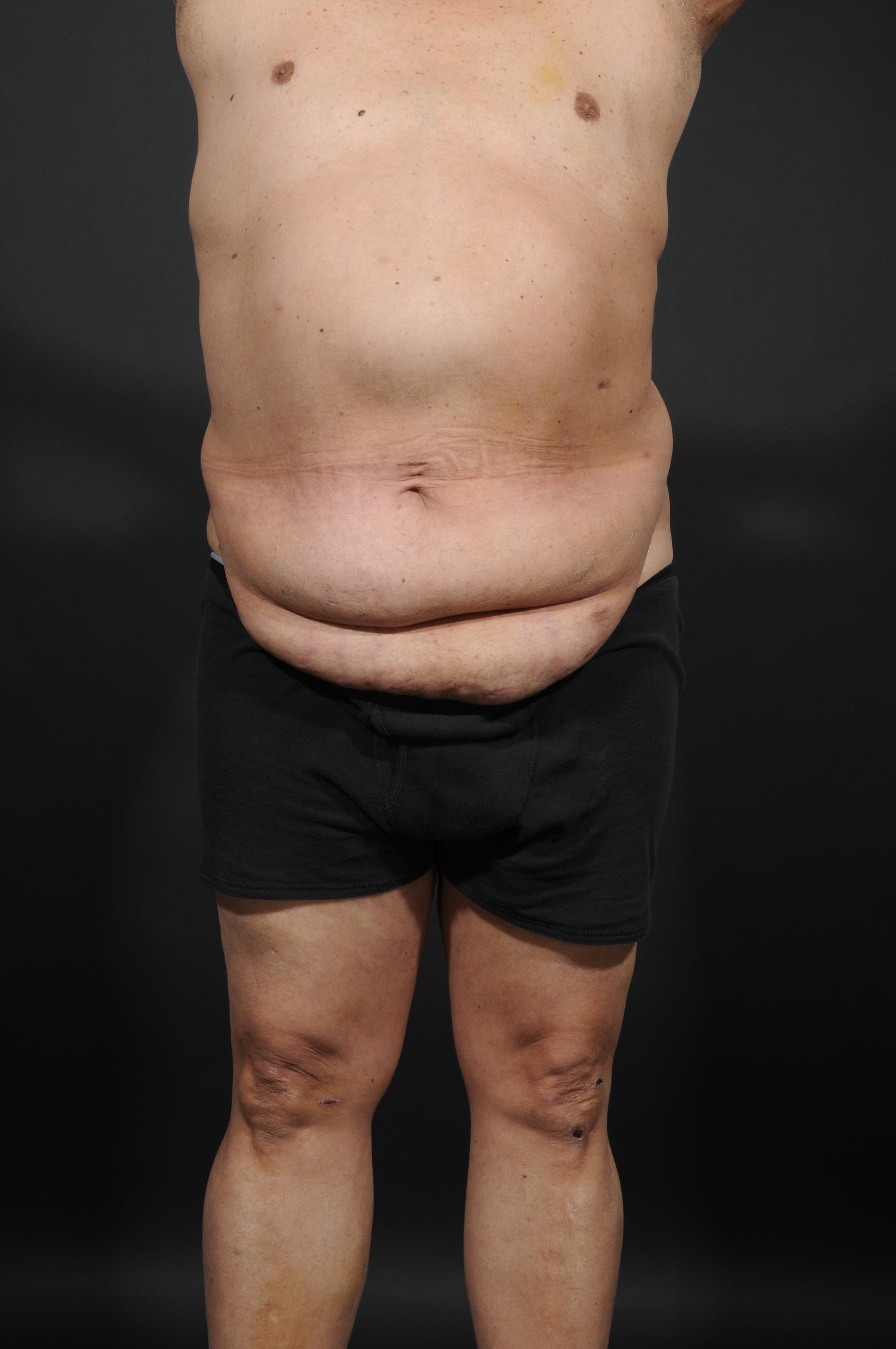 Male Abdominoplasty Before & After Image