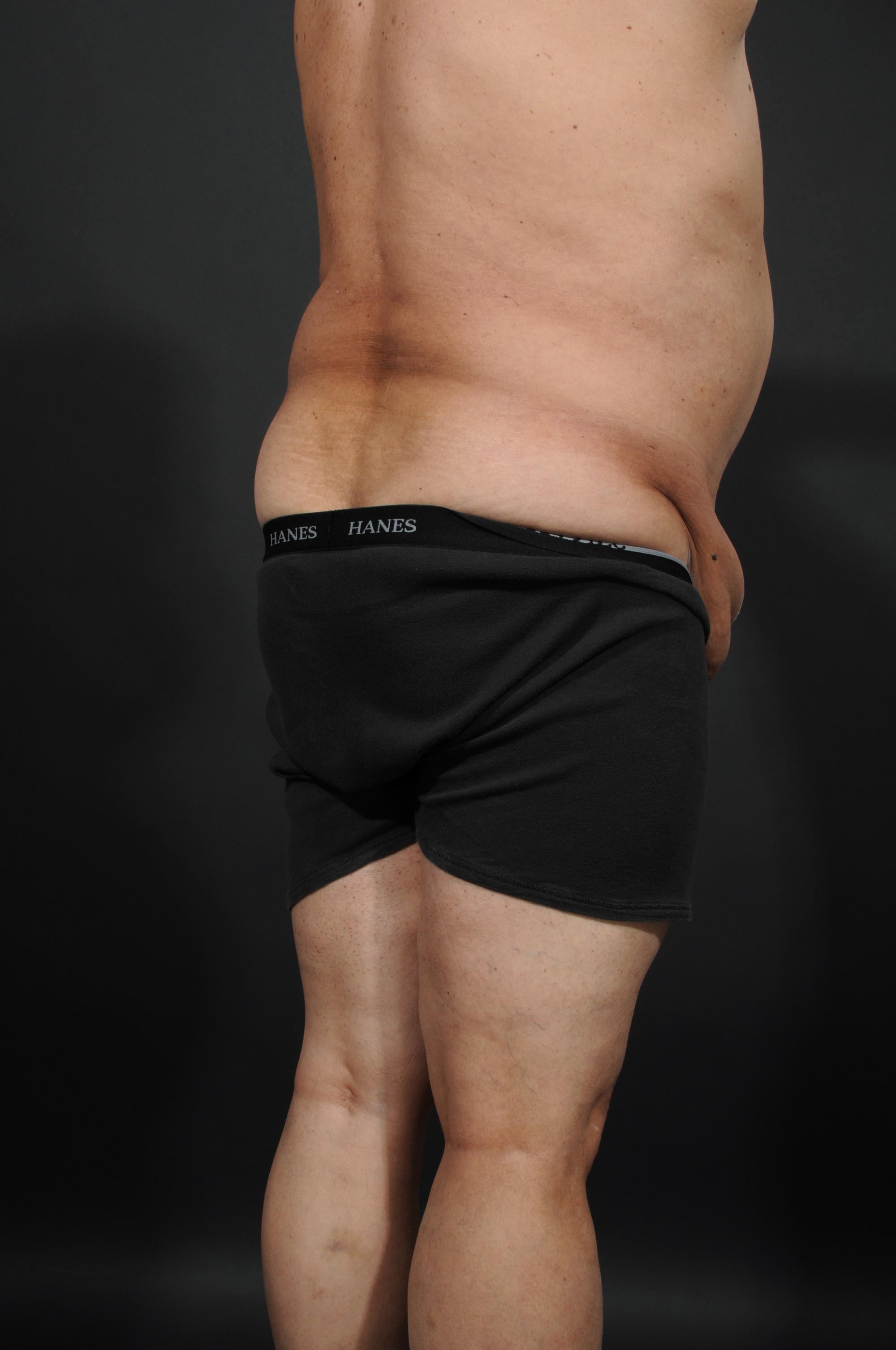 Male Abdominoplasty Before & After Image