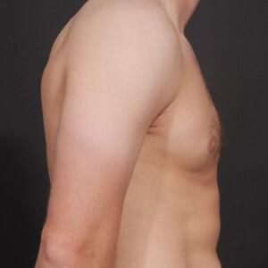 Male Breast Reduction Before & After Image