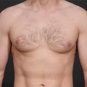 Male Breast Reduction Before & After Image