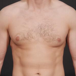 Male Breast Reduction Before & After Image