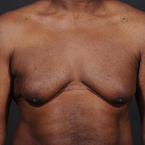 Male Breast Reduction Before & After Image