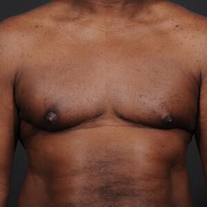 Male Breast Reduction Before & After Image