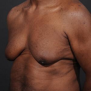 Male Breast Reduction Before & After Image