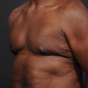 Male Breast Reduction Before & After Image