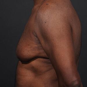 Male Breast Reduction Before & After Image