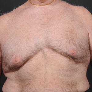 Male Breast Reduction Before & After Image