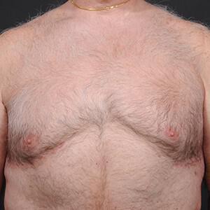 Male Breast Reduction Before & After Image