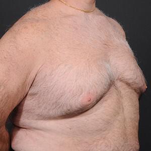 Male Breast Reduction Before & After Image