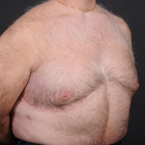 Male Breast Reduction Before & After Image