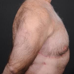 Male Breast Reduction Before & After Image