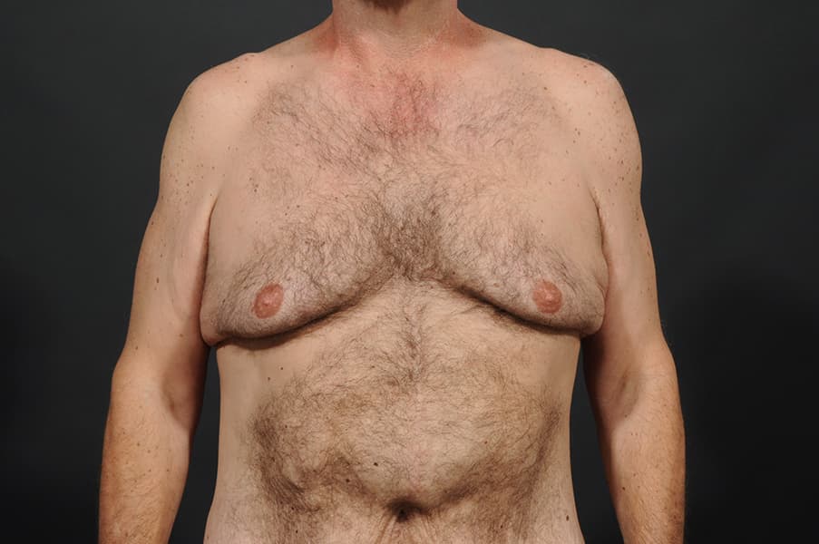 Male Breast Reduction Before & After Image