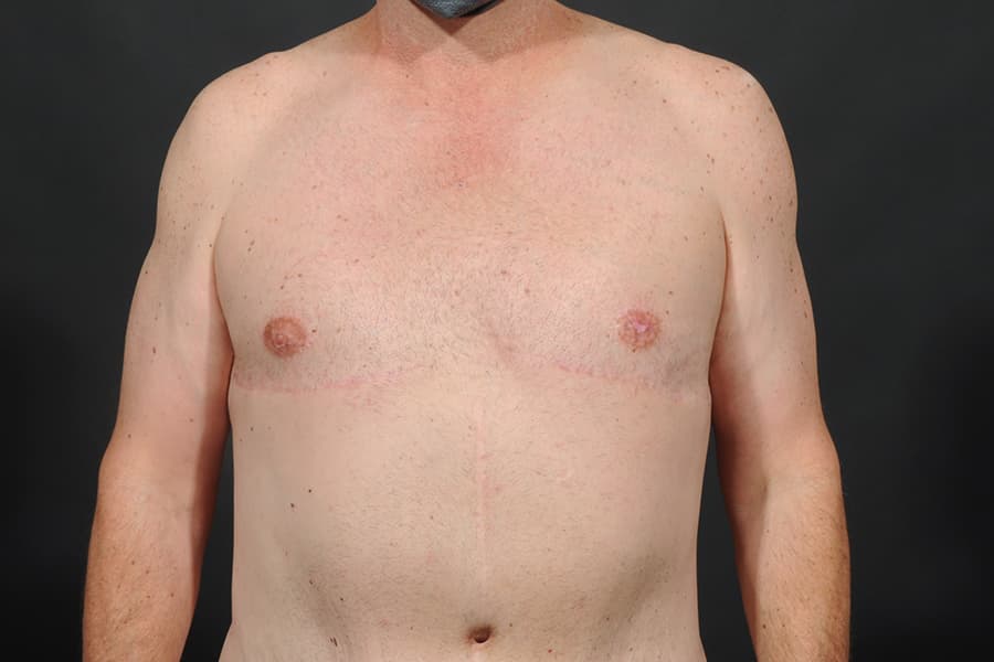 Male Breast Reduction Before & After Image