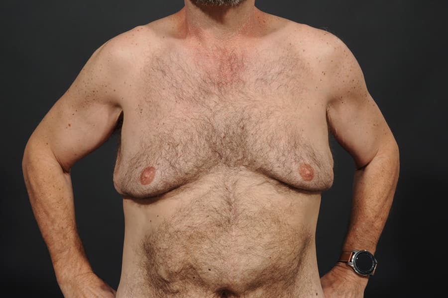 Male Breast Reduction Before & After Image