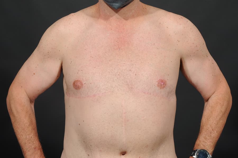 Male Breast Reduction Before & After Image