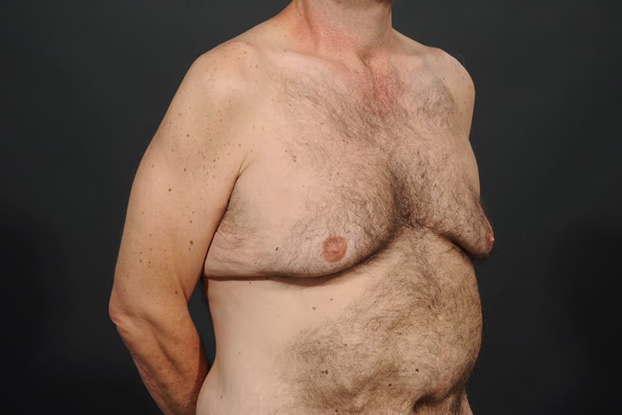 Male Breast Reduction Before & After Image