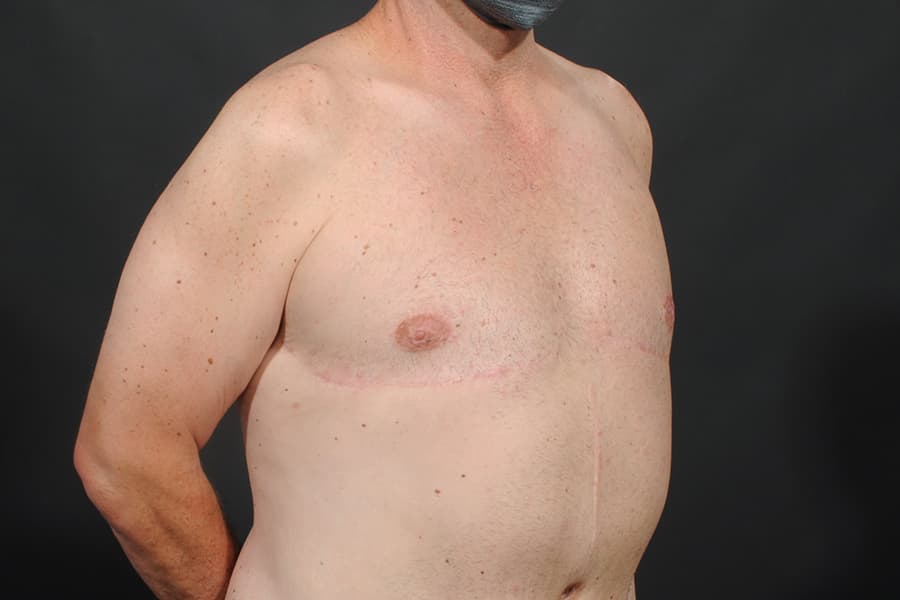 Male Breast Reduction Before & After Image